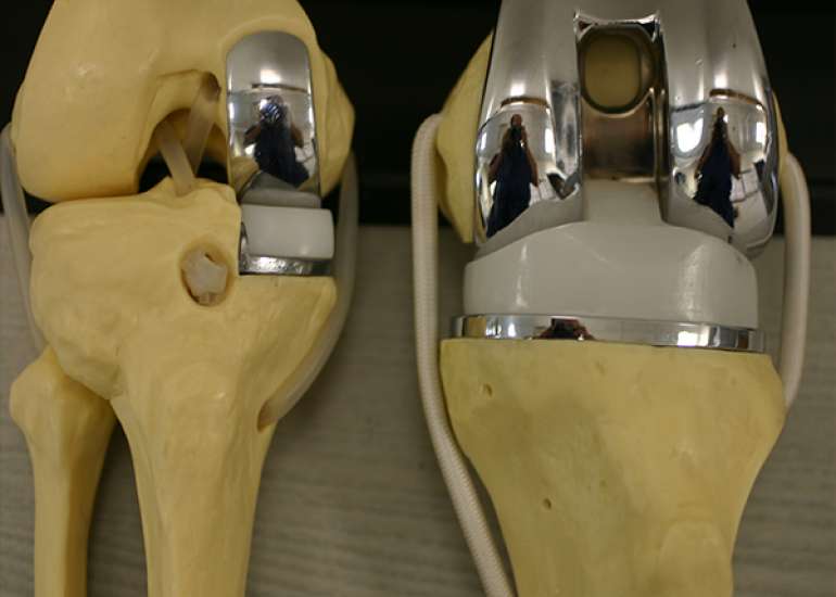 What is partial knee replacement?