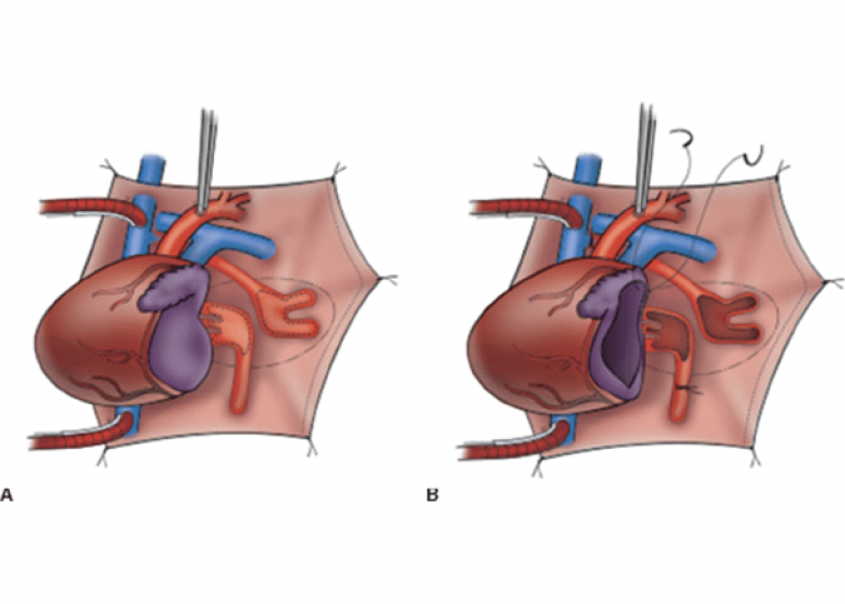 What is prognosis of TAPVC (Total anomalous pulmonary venous connection) type of cases?