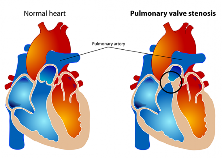 What is pulmonary stenosis?