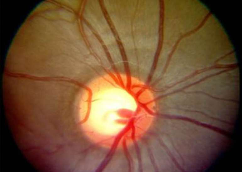 What is steroid induced glaucoma?