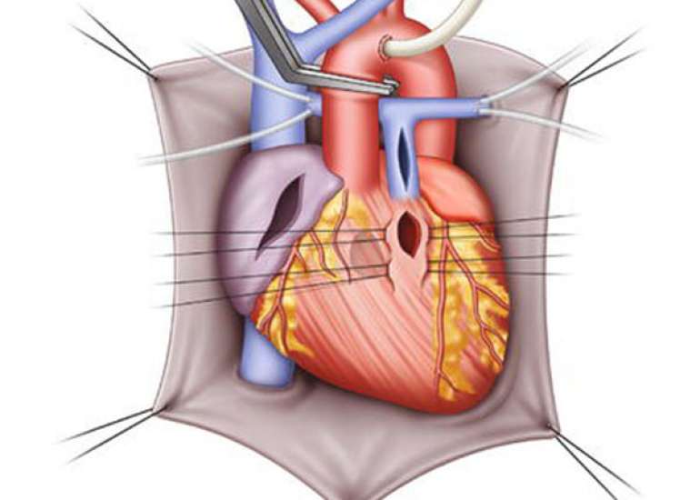 What is the outcome of TOF repair?