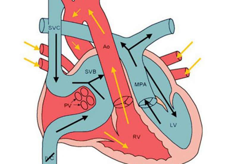 What is the transposition of great arteries (TGA)?