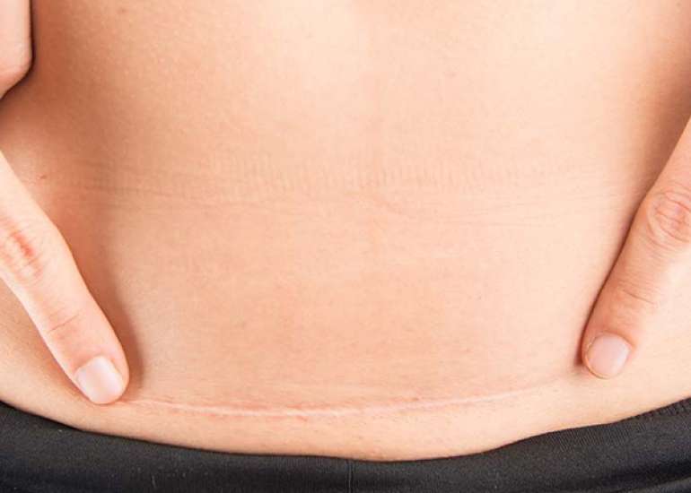 What should you prefer: Continuous or disrupted subcutaneous tissue closure?