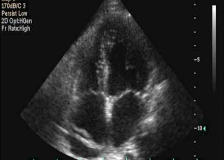 Whats the significance of interatrial septal aneurysm?