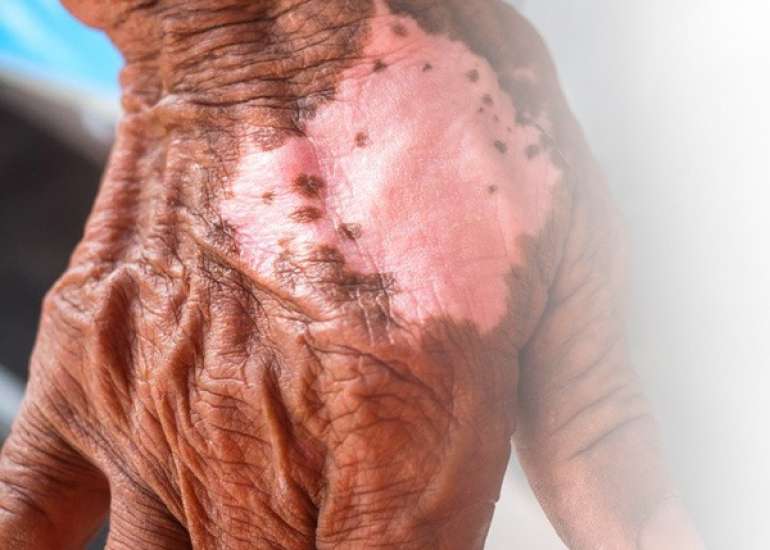 Leprosy: Symptoms & Treatment