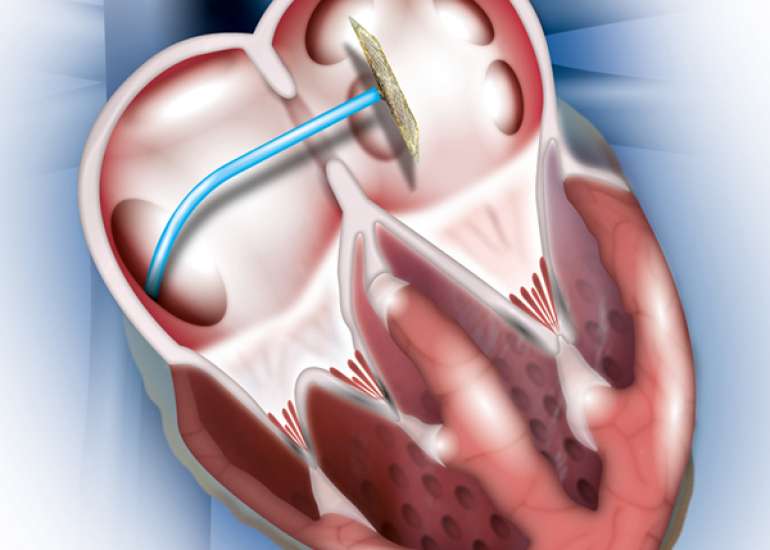 When should ASD closure be done?