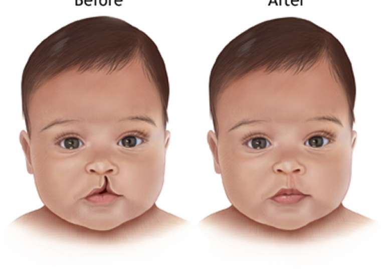 When should a child be operated upon for a cleft lip or a cleft palate?