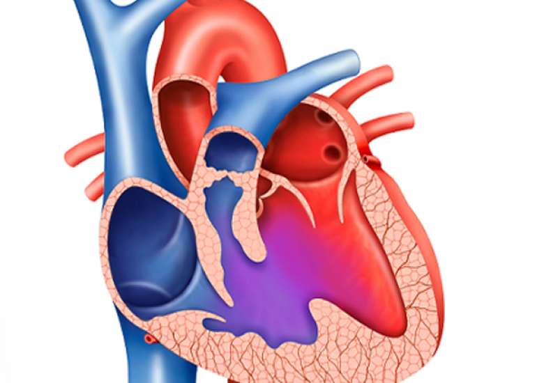 When do we intervene in VSD (Ventricular septic defect)?