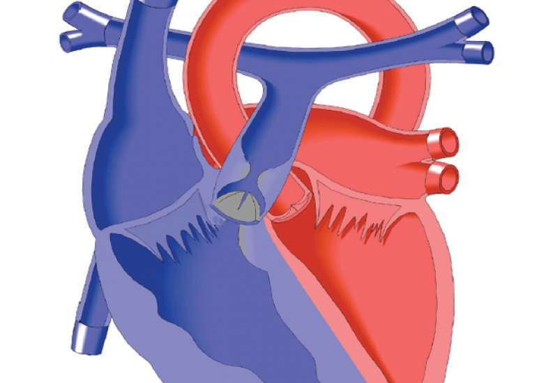 When to intervene in pulmonary stenosis?