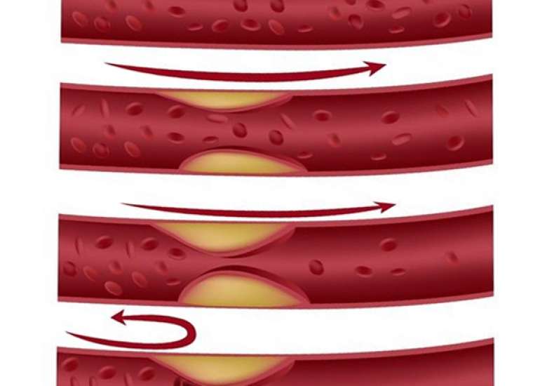 When to intervene when one artery of a patient is 100% is blocked?