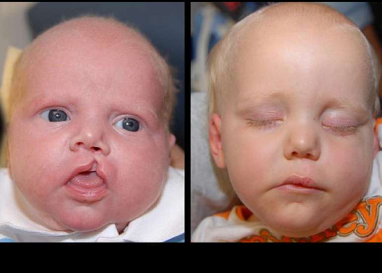 Where can I get a cleft lip and cleft palate surgery done?