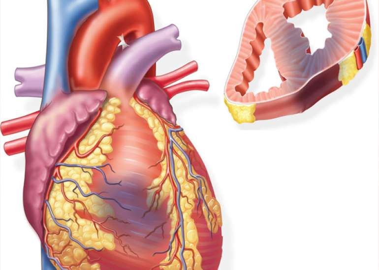 Which antiplatelet should we use in acute MI and why?