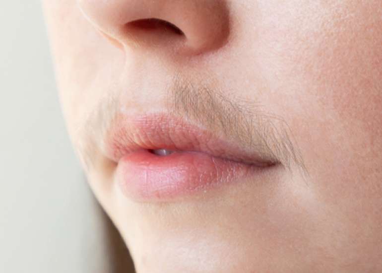 Which Hormone Should You Assess in Hirsutism: Testosterone or Dihydrotestosterone?