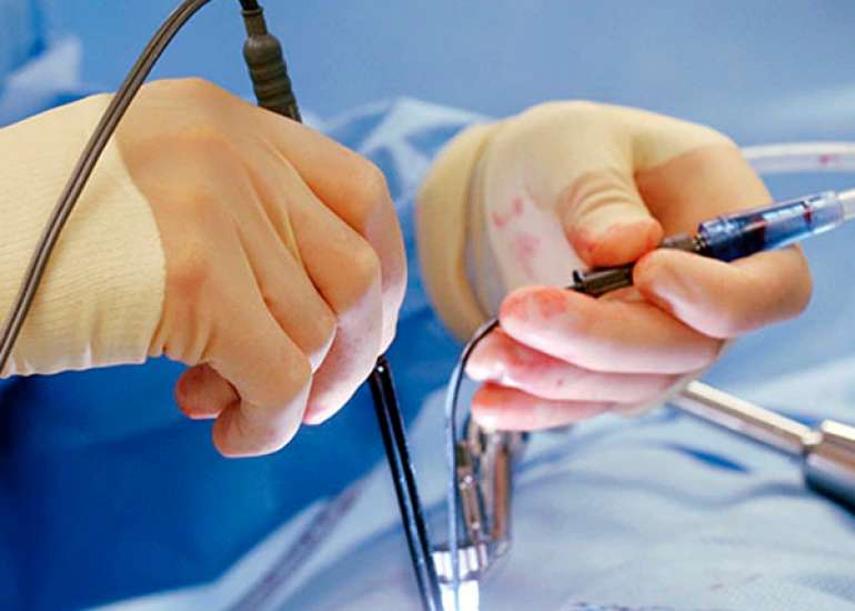 Which Laparoscopic Entry Technique is the Preferred Choice?