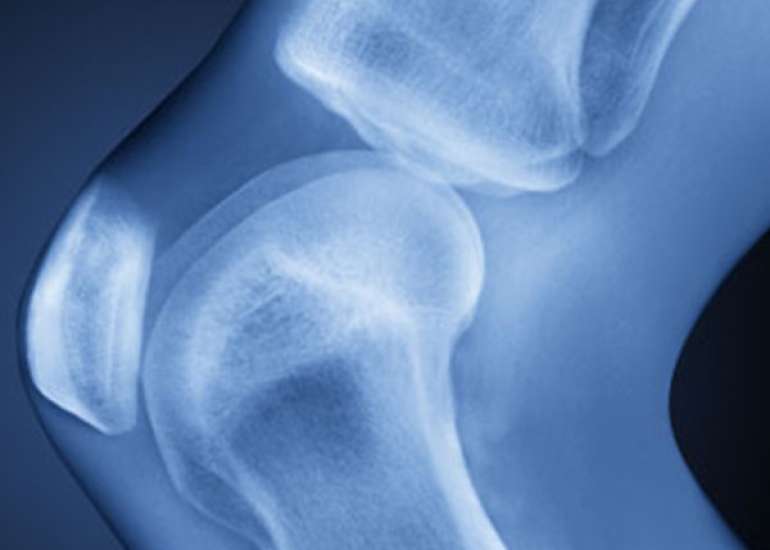 Which joints are commonly involved in osteoarthritis?