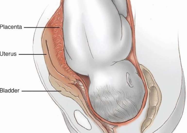 A Rare Case of Secondary Abdominal Pregnancy with Placental Implantation between Leaves of Broad Ligament