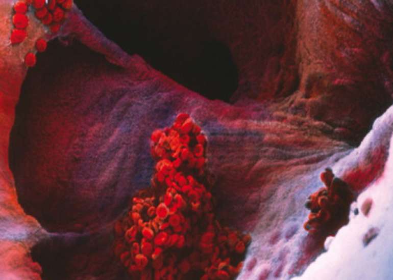 When should we use abciximab in acute MI?