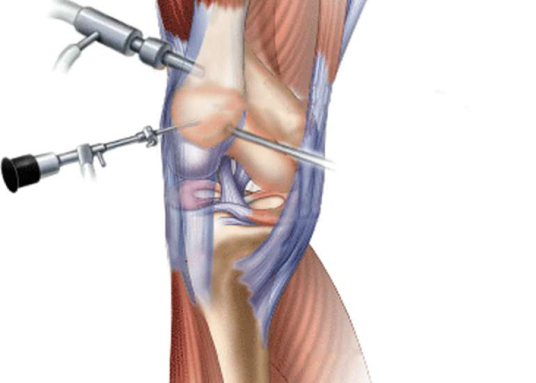What is the role of arthroscopy in osteoarthritis knee?