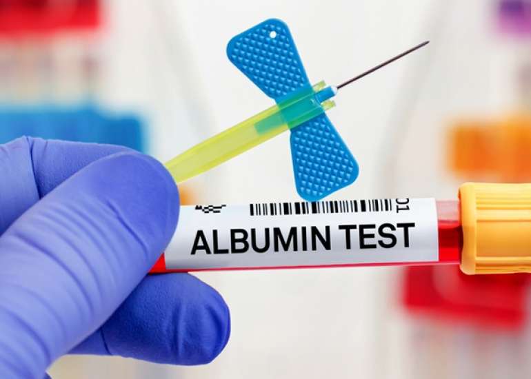 एल्ब्यूमिन रक्त परीक्षण क्या है?| Albumin Blood Test in Hindi
