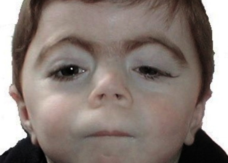 All You Need To Know About Cornelia de Lange Syndrome