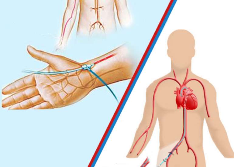 Radial angiography & angioplasty vs. Femoral angiography & angioplasty?