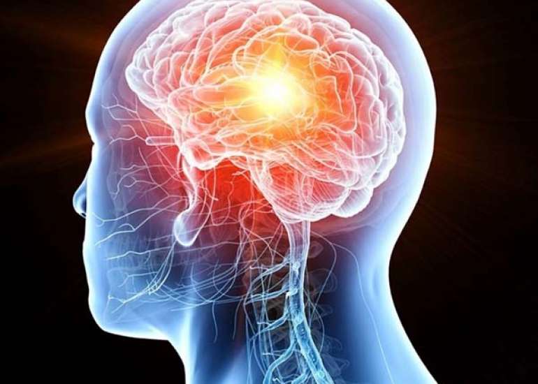 अरचनोइड सिस्ट क्या है? कारण, लक्षण और इलाज | Arachnoid Cysts in Hindi  