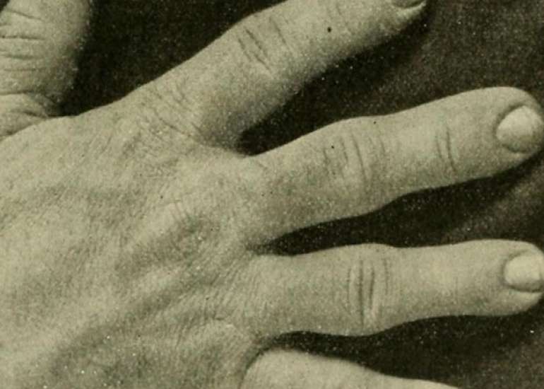 एक्रोमेगाली एक गंभीर विकार – कारण, लक्षण और इलाज सब जाने | Acromegaly Disease in Hindi