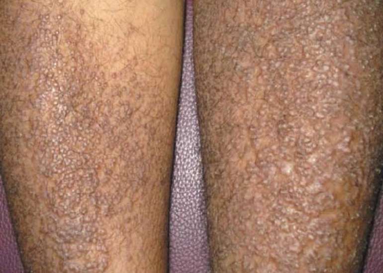 Amyloidosis - Symptoms and Causes- Medtalks