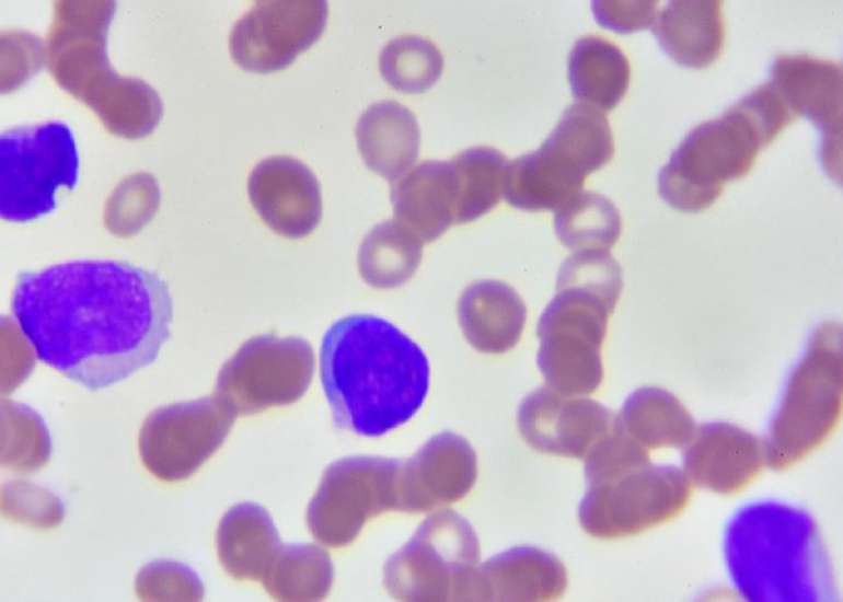 बेसोफिलिया क्या है? कारण, लक्षण और इलाज | Basophilia in Hindi