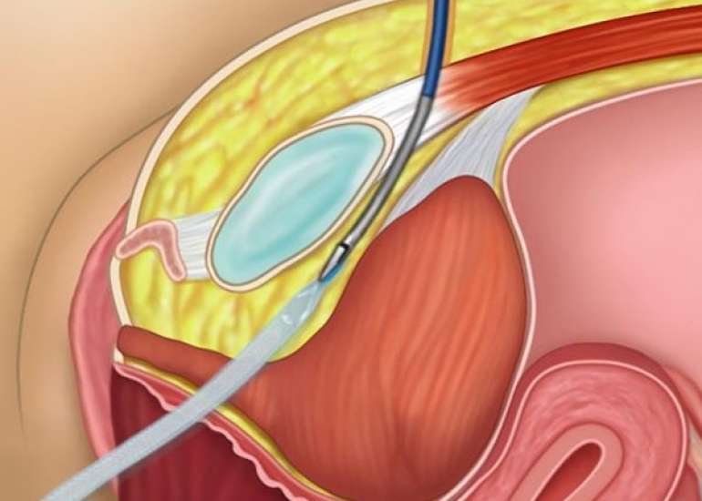 मूत्राशय की सर्जरी के बारे में आप क्या जानते हैं | Bladder Surgery in Hindi