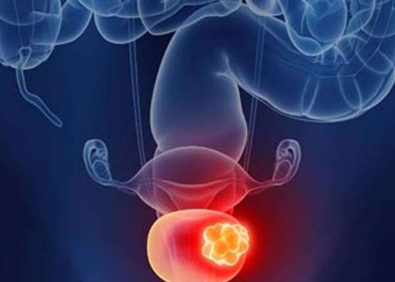ब्लैडर कैंसर एक गंभीर समस्या – कारण, लक्षण, चरण और उपचार |  Bladder Cancer in Hindi