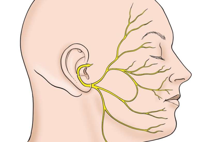 रामसे हंट सिंड्रोम क्या है? लक्षण, कारण और इलाज | Ramsay Hunt Syndrome in Hindi