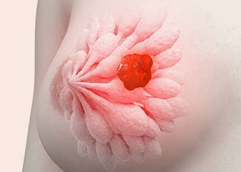 स्तन कैंसर क्या है? कारण, लक्षण, और उपचार | Breast Cancer in Hindi