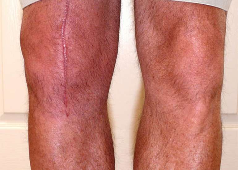 What are the complications after knee replacement?