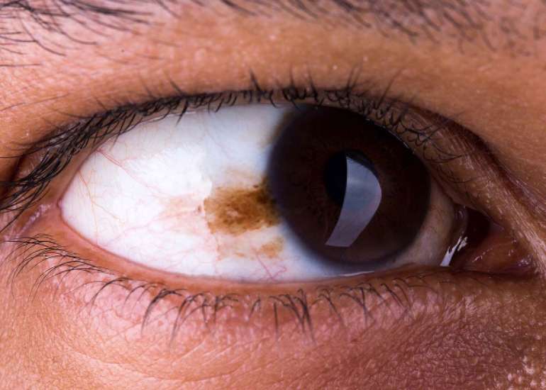 आँख का कैंसर क्या है? | Eyes Cancer in Hindi