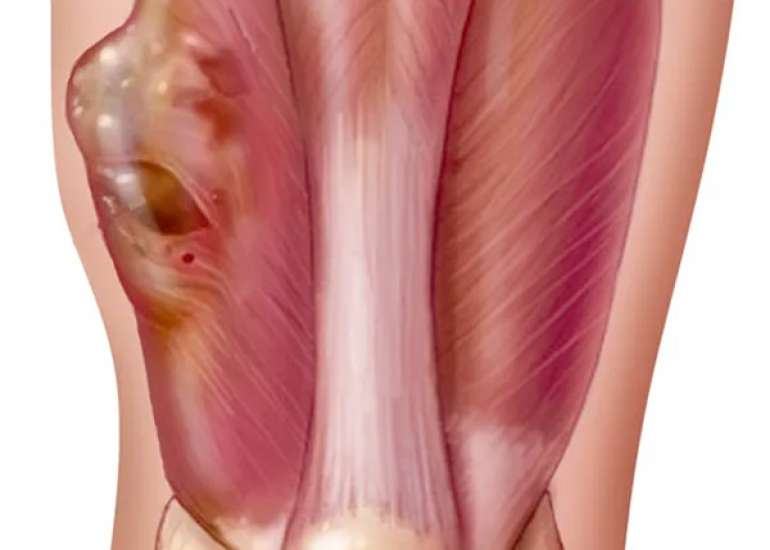 सारकोमा कैंसर क्या है? कारण, लक्षण, प्रकार और बचाव | Sarcoma Cancer in Hindi