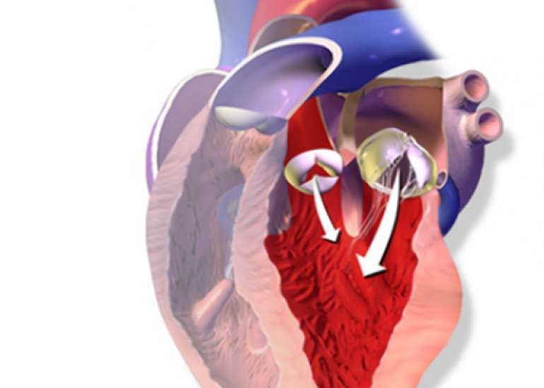 What are the guidelines for intervention in a case with aortic regurgitation?