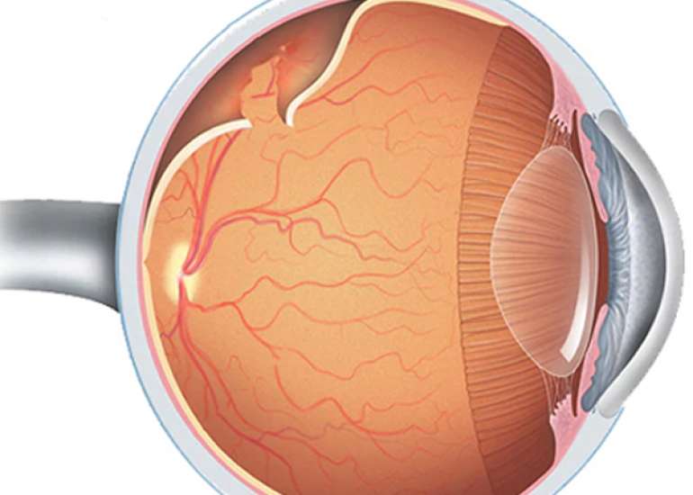 What are the common diseases that have an impact on the retina?