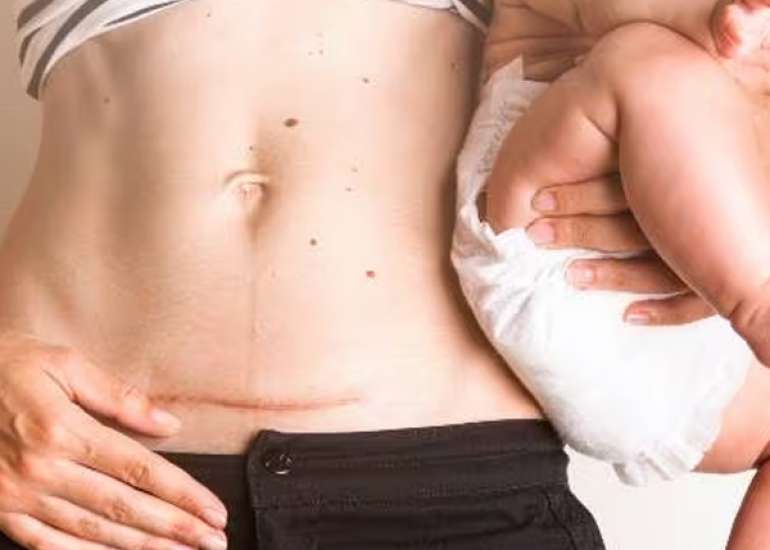 Cesarean Delivery (C-Section): All You Must Know