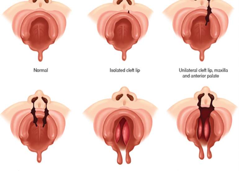 What is the Incidence of Cleft lip and Cleft Palate?