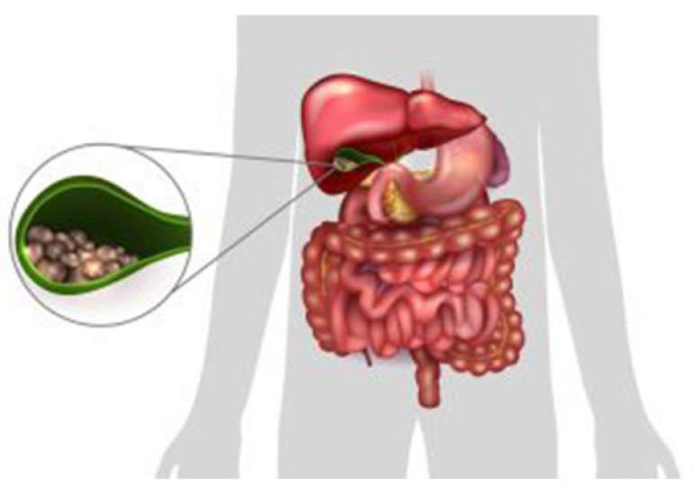 How should we manage biliary colic?