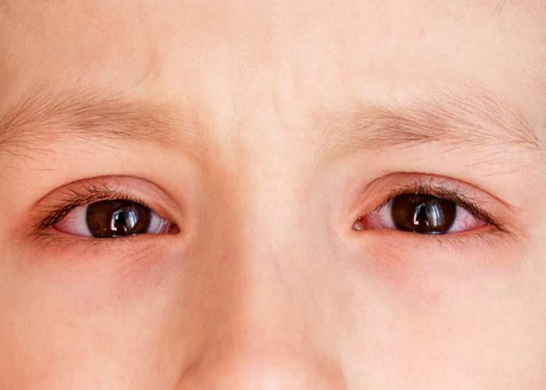 What are the common eye diseases in children?