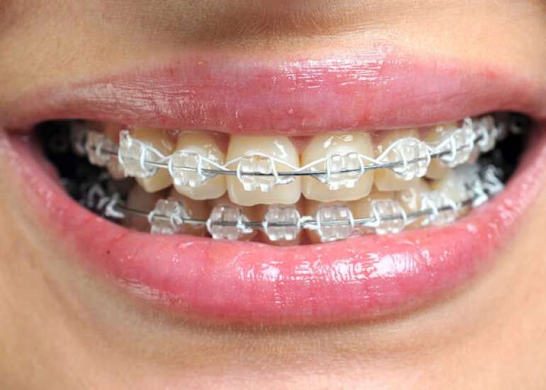 What everybody should know about dental braces?