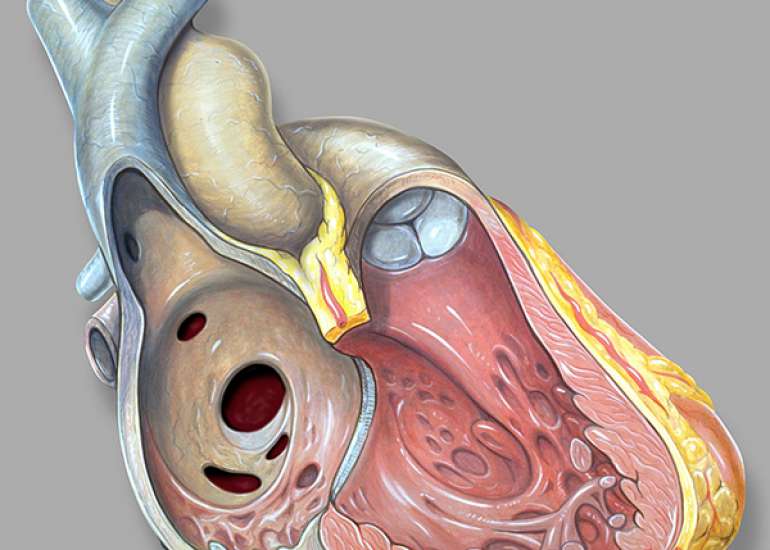 When do we intervene in ASD (Atrial septic defect)?