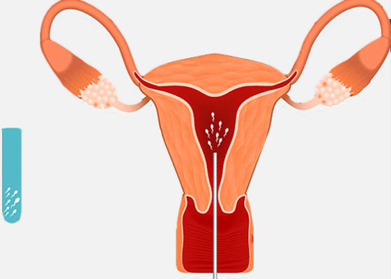 All about emotional support during infertility evaluation?