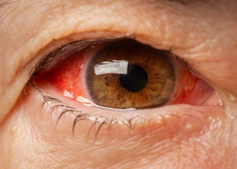 आई स्ट्रोक क्या है? कारण, लक्षण, और इलाज | Eye Stroke in Hindi