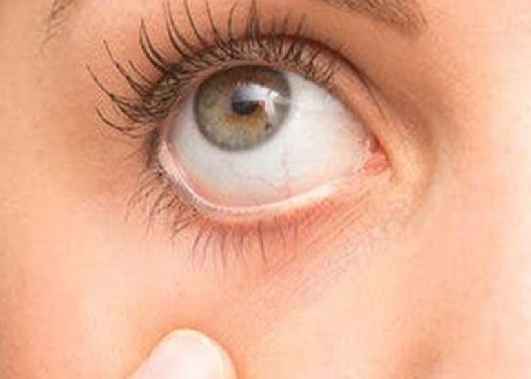 ड्राई आई सिंड्रोम – कारण, लक्षण और उपचार | Dry Eye Syndrome in Hindi