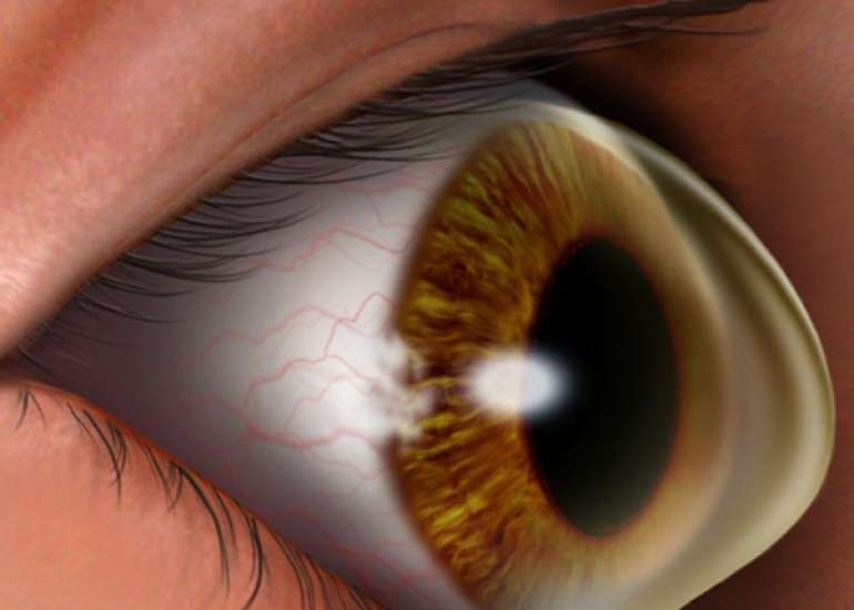 केराटोकोनस क्या है? कारण, लक्षण और इलाज | Keratoconus ke karan, lakshan, ilaj, Dawa, upchar in Hindi