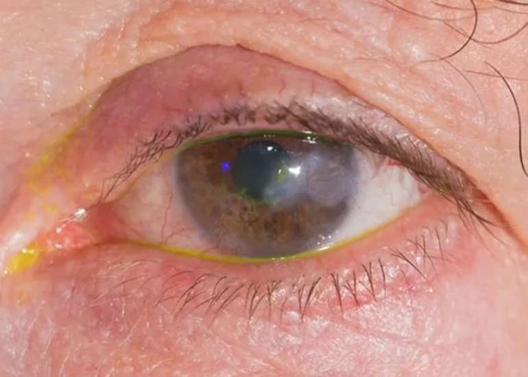 केराटाइटिस क्या है? लक्षण, कारण, प्रकार, और इलाज | Keratitis in Hindi