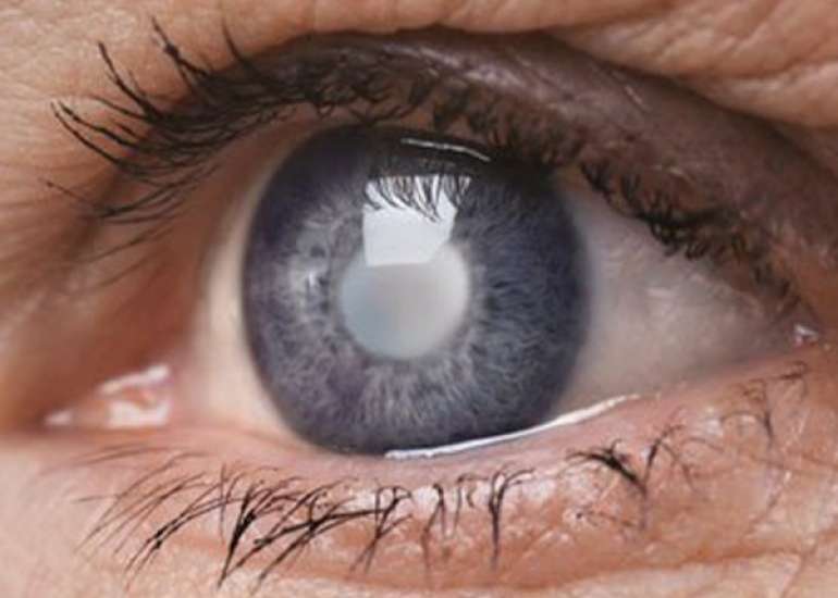 ग्लूकोमा यानि काला मोतिया कैसे गंभीर | Glaucoma in Hindi